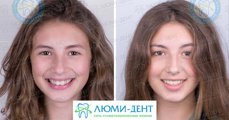 Как брекеты меняют форму лица — рассказывает ортодонт Аверина Елена Александровна Брекеты: до и после лечения (фото)